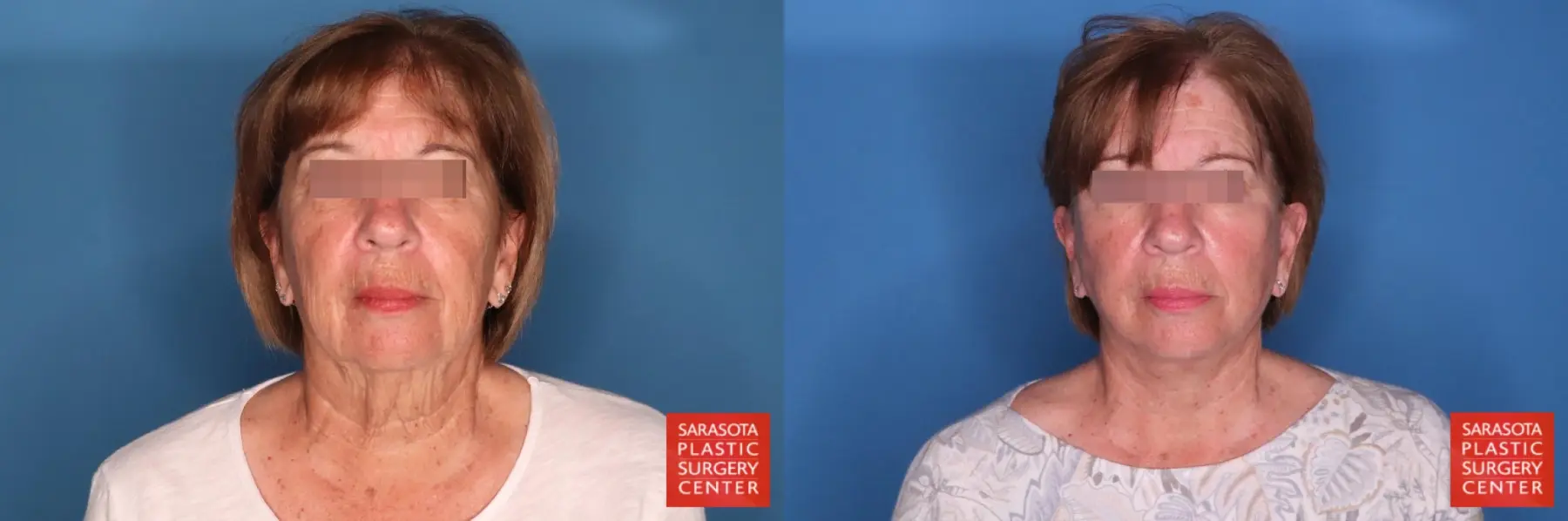 Facelift: Patient 78 - Before and After 1