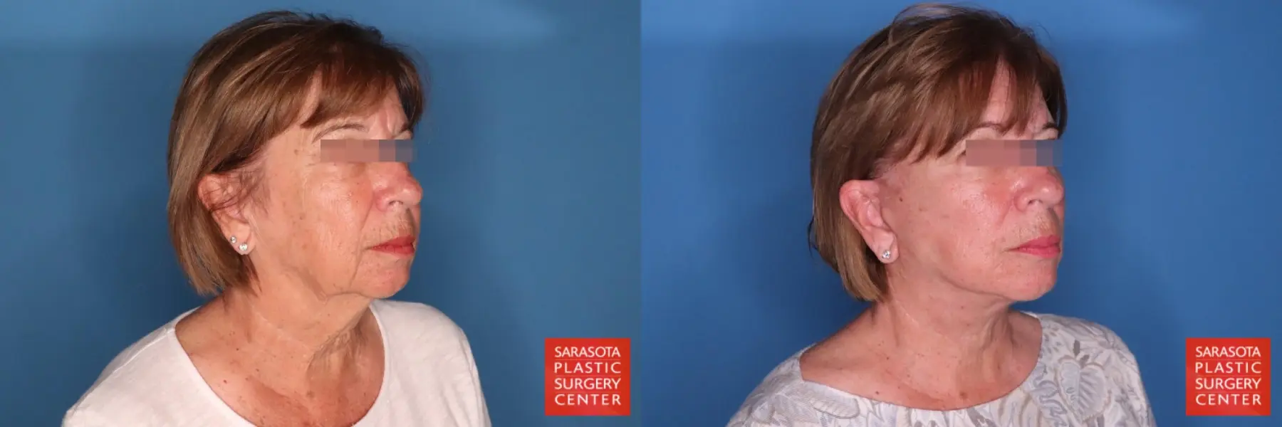 Facelift: Patient 78 - Before and After 4