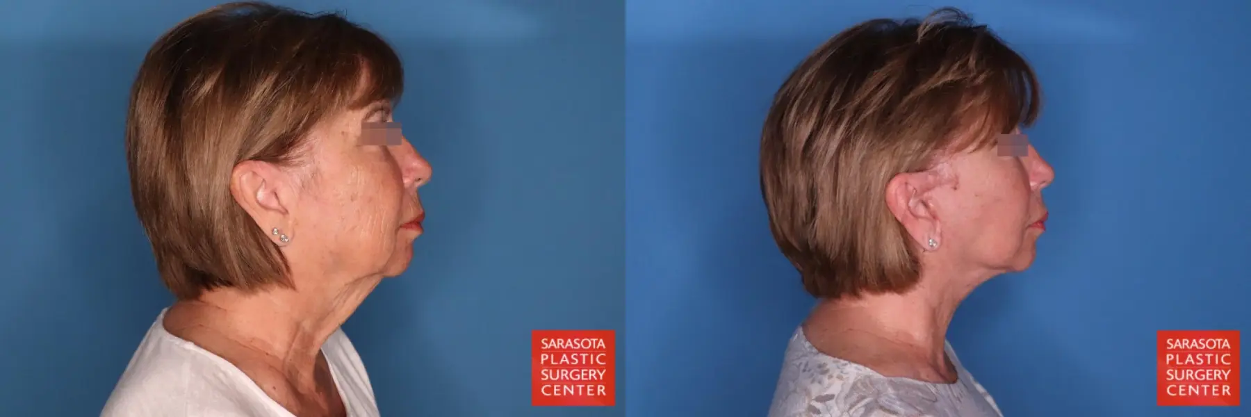 Facelift: Patient 78 - Before and After 5