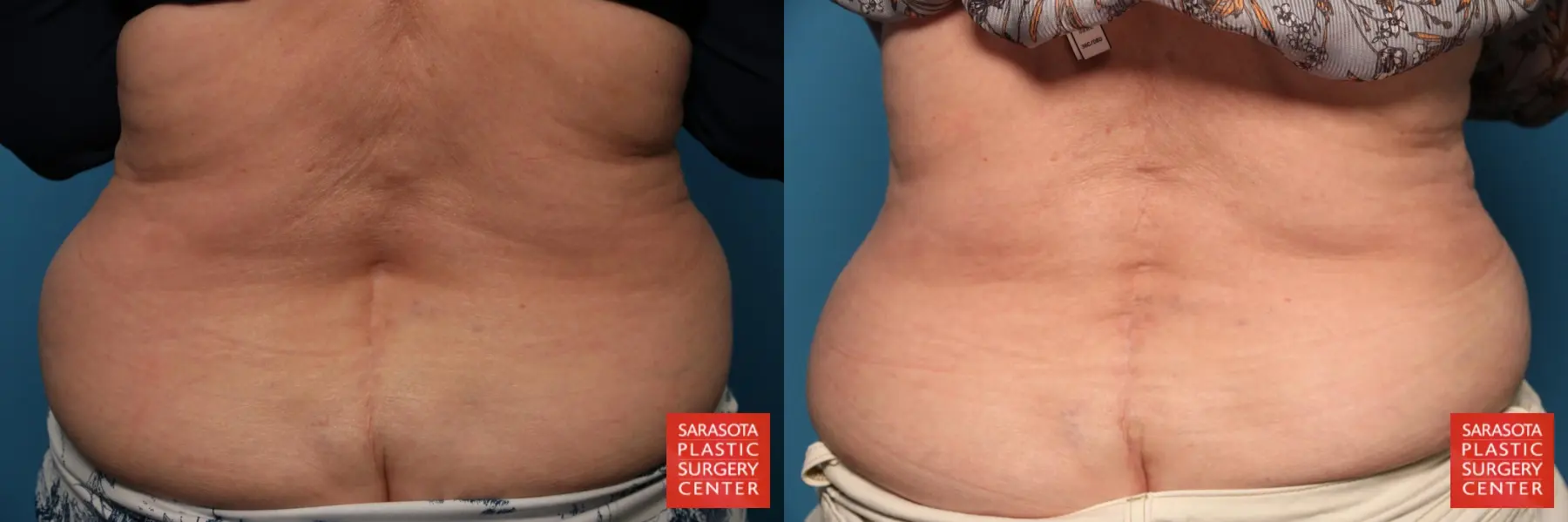 Fat Transfer - Body: Patient 6 - Before and After  