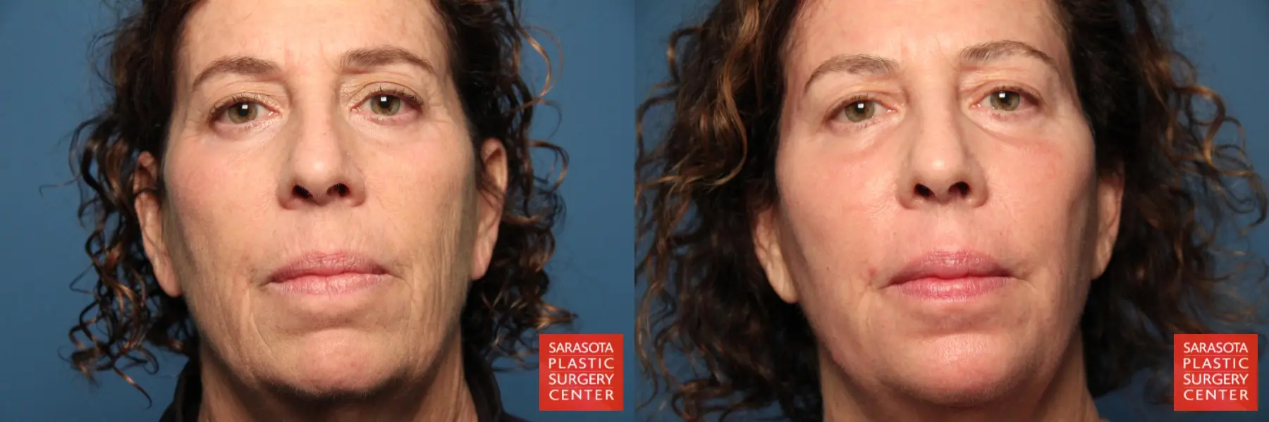 Fat Transfer - Face: Patient 15 - Before and After  