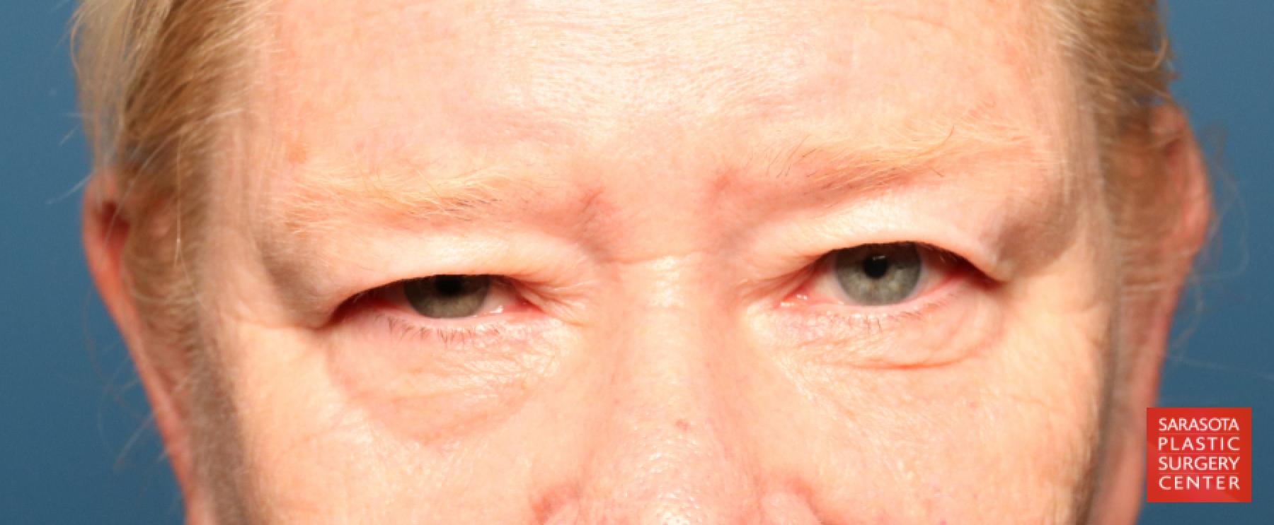Blepharoplasty: Patient 29 - Before 