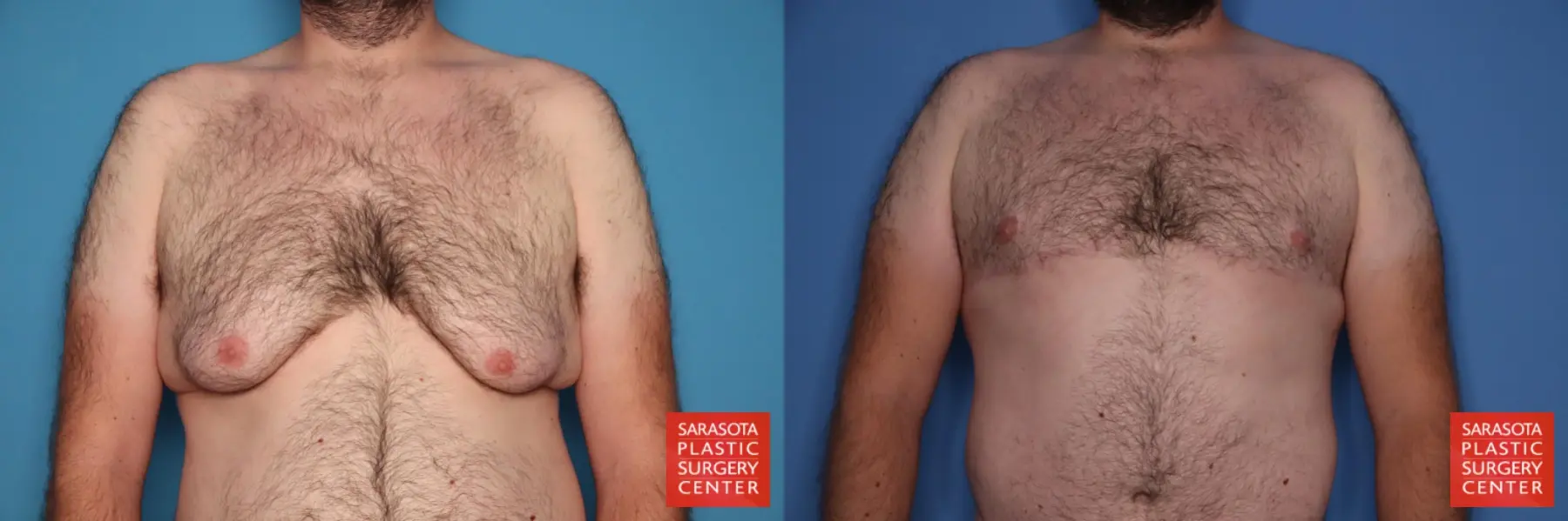 Gynecomastia: Patient 20 - Before and After  