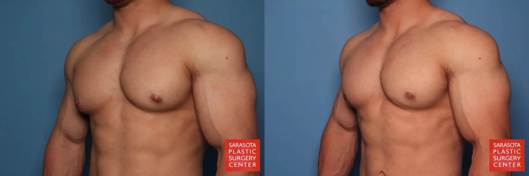 Gynecomastia: Patient 6 - Before and After 2