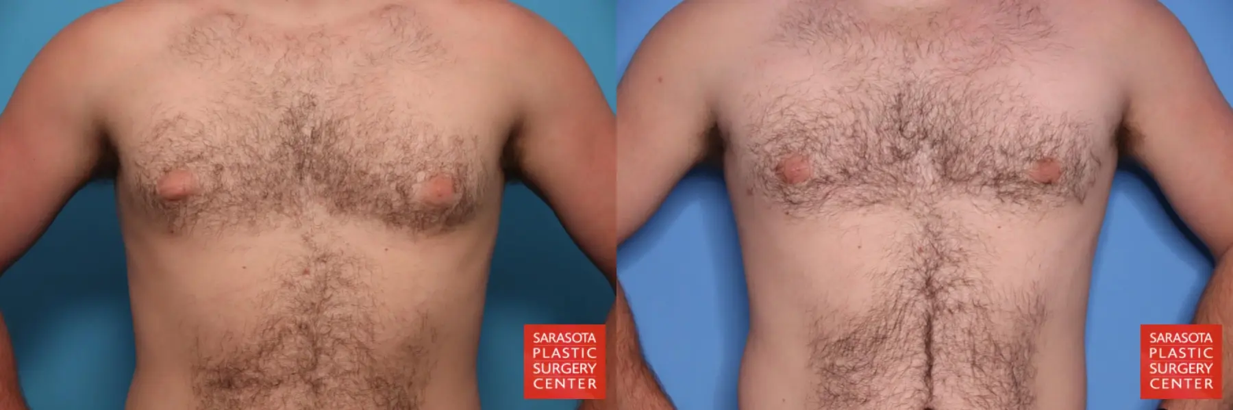 Gynecomastia: Patient 3 - Before and After 6