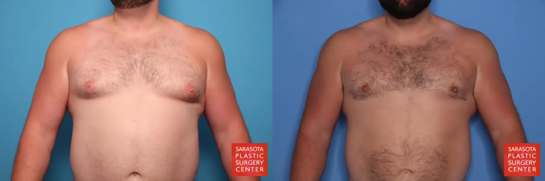 Gynecomastia: Patient 23 - Before and After  