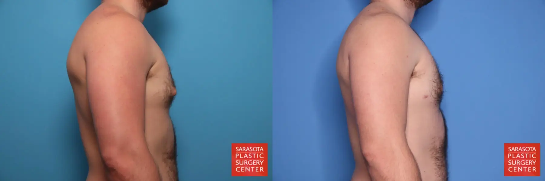 Gynecomastia: Patient 3 - Before and After 5
