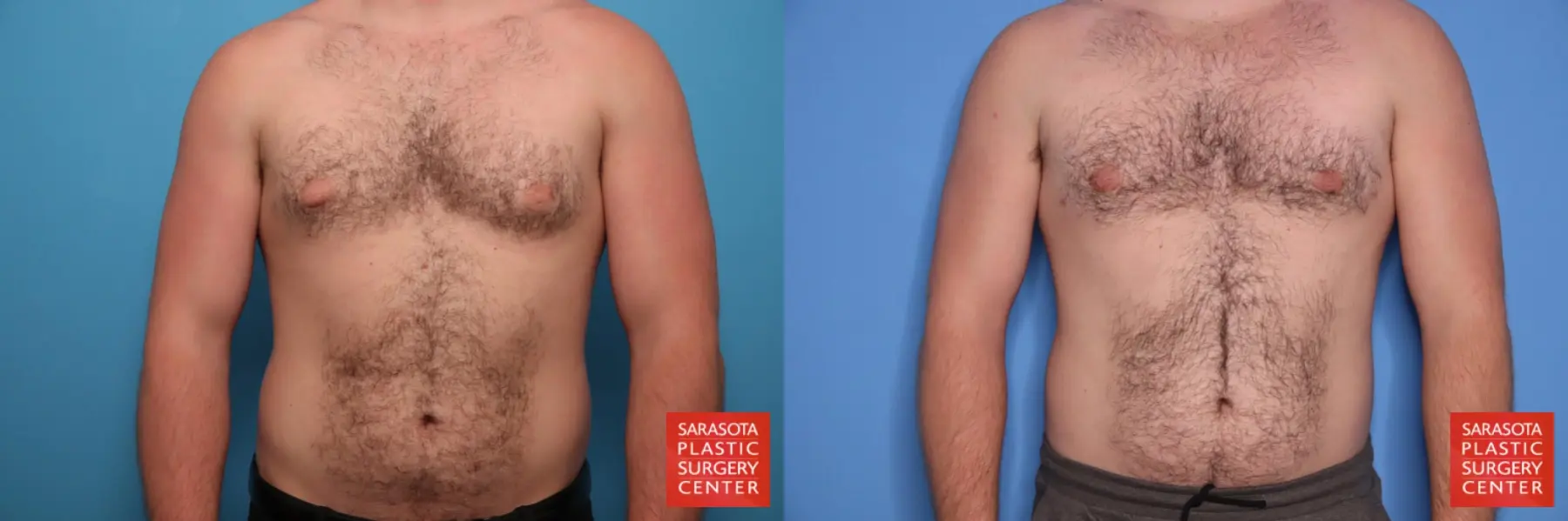 Gynecomastia: Patient 3 - Before and After  