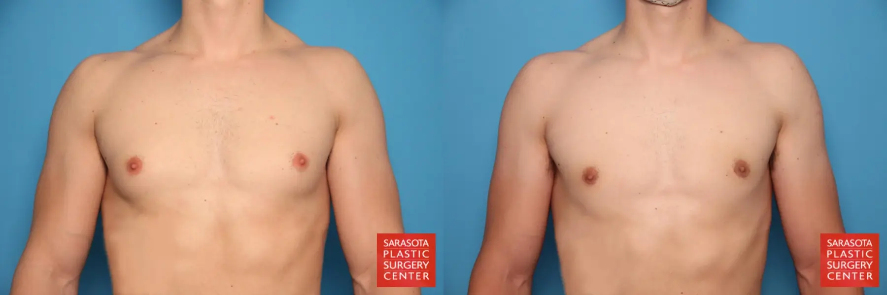 Gynecomastia: Patient 22 - Before and After  