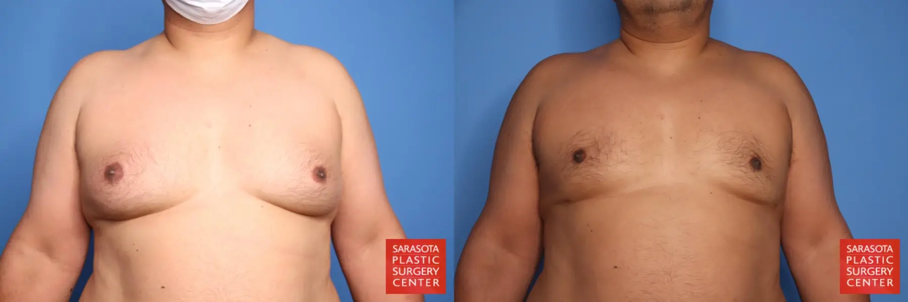 Gynecomastia: Patient 11 - Before and After  
