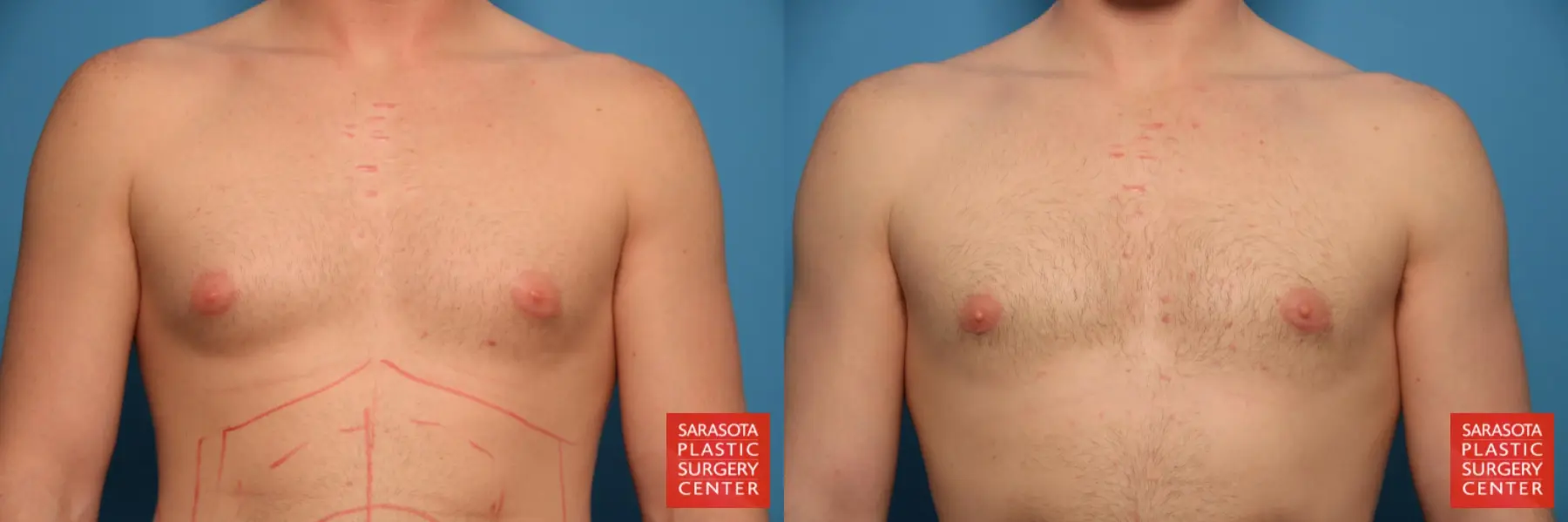 Gynecomastia: Patient 5 - Before and After  