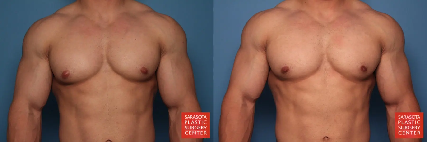 Gynecomastia: Patient 6 - Before and After  