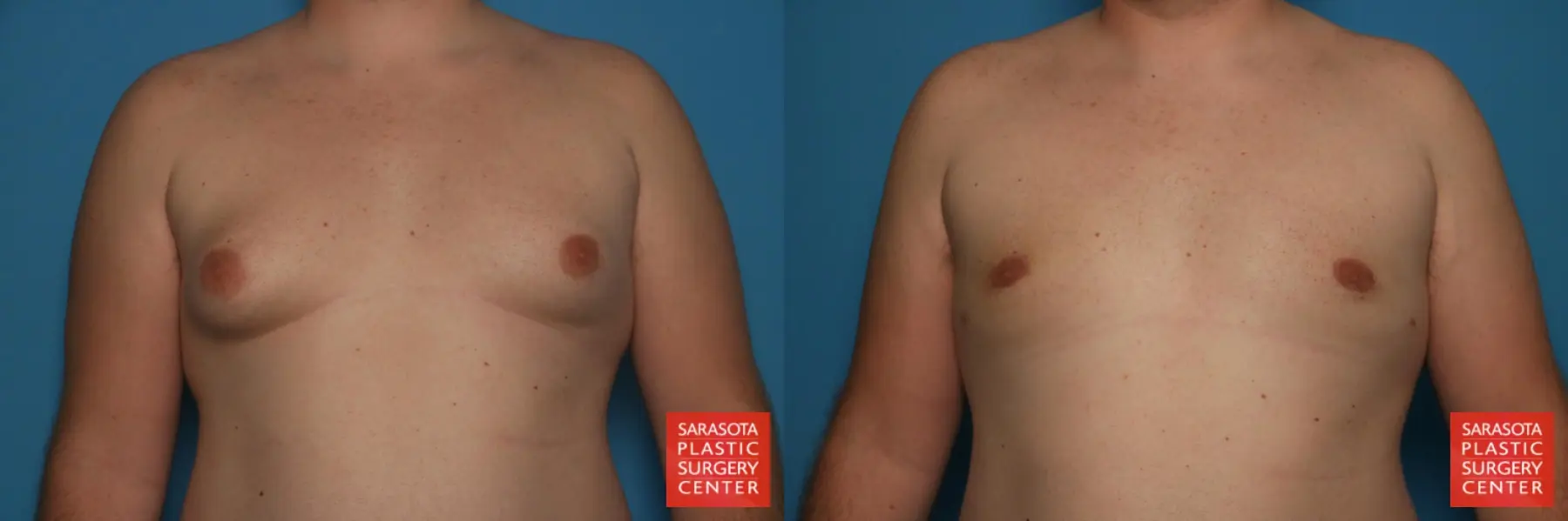 Gynecomastia: Patient 24 - Before and After  