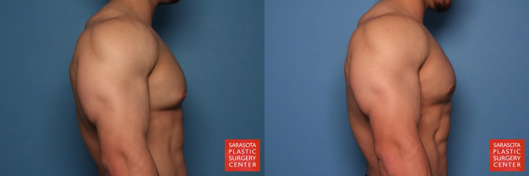 Gynecomastia: Patient 6 - Before and After 5
