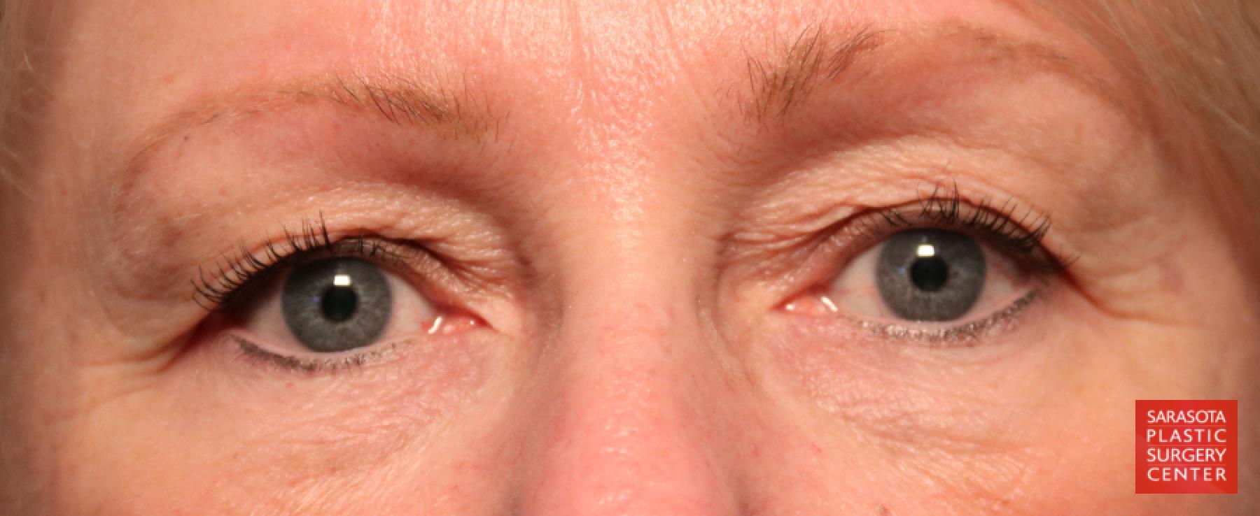Blepharoplasty: Patient 24 - Before 