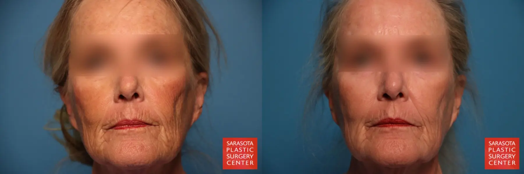 Laser Skin Resurfacing - Face: Patient 12 - Before and After  