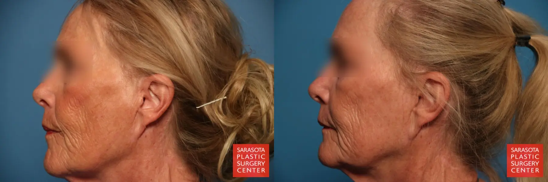 Laser Skin Resurfacing - Face: Patient 12 - Before and After 3