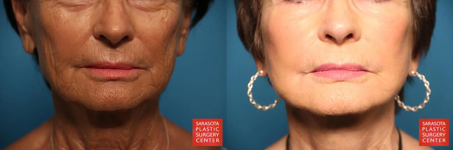 Laser Skin Resurfacing - Face: Patient 10 - Before and After  