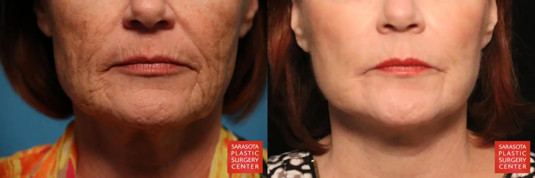 Laser Skin Resurfacing - Face: Patient 22 - Before and After 2
