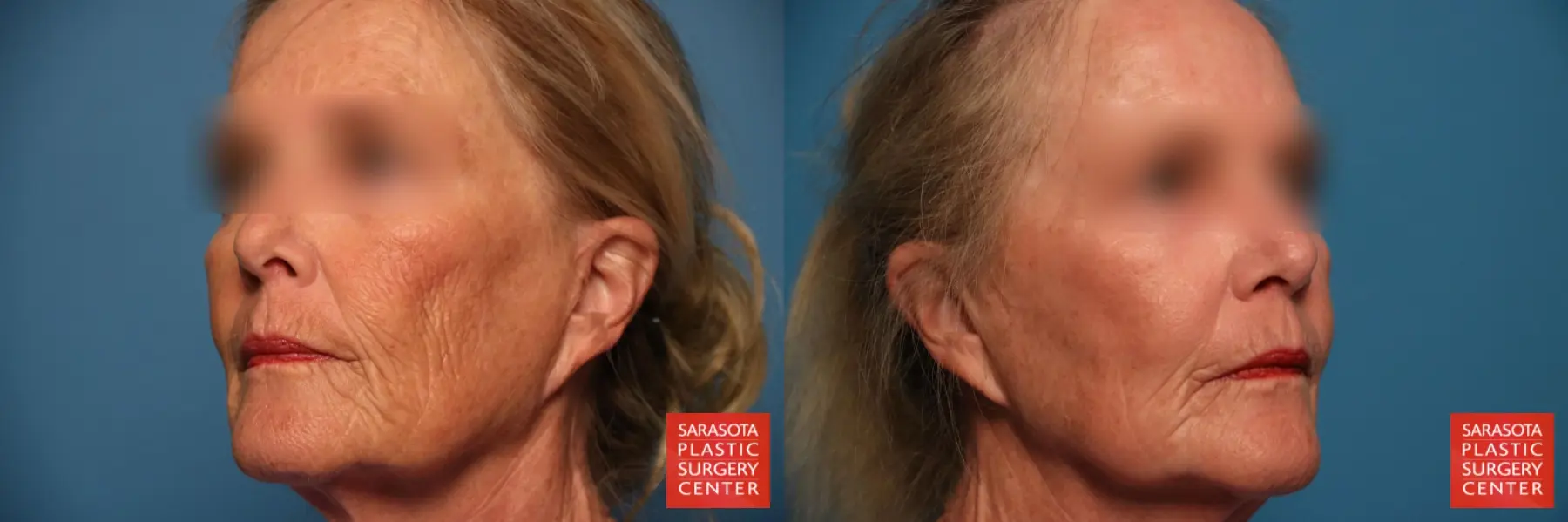 Laser Skin Resurfacing - Face: Patient 12 - Before and After 2