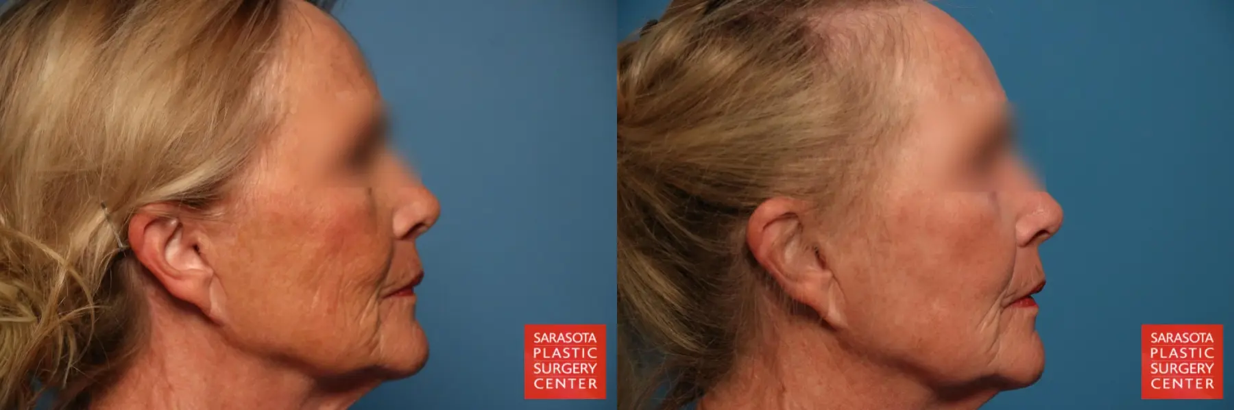 Laser Skin Resurfacing - Face: Patient 12 - Before and After 5