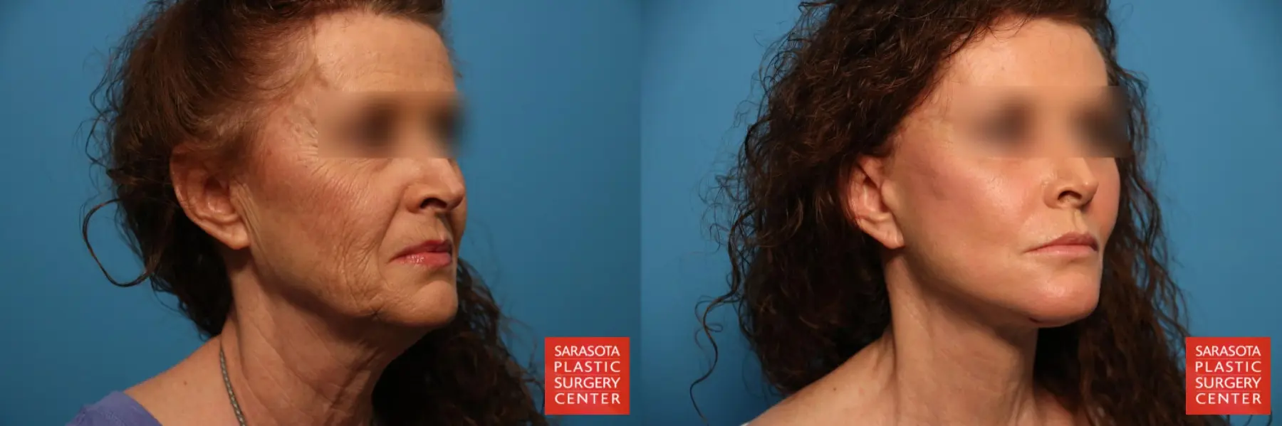 Laser Skin Resurfacing - Face: Patient 24 - Before and After 2
