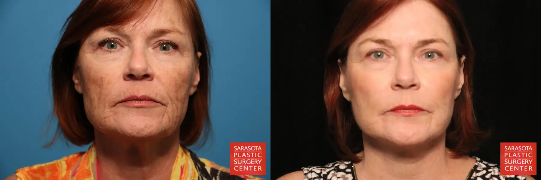 Laser Skin Resurfacing - Face: Patient 22 - Before and After  