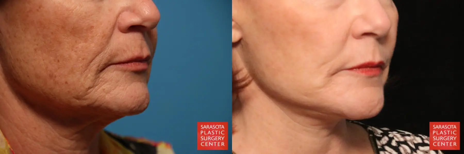 Laser Skin Resurfacing - Face: Patient 22 - Before and After 4