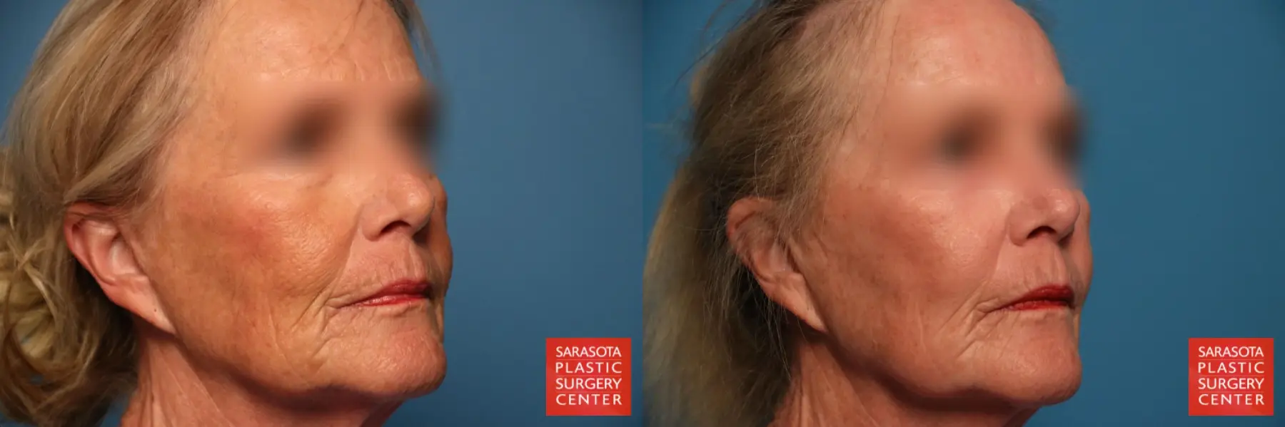 Laser Skin Resurfacing - Face: Patient 12 - Before and After 4