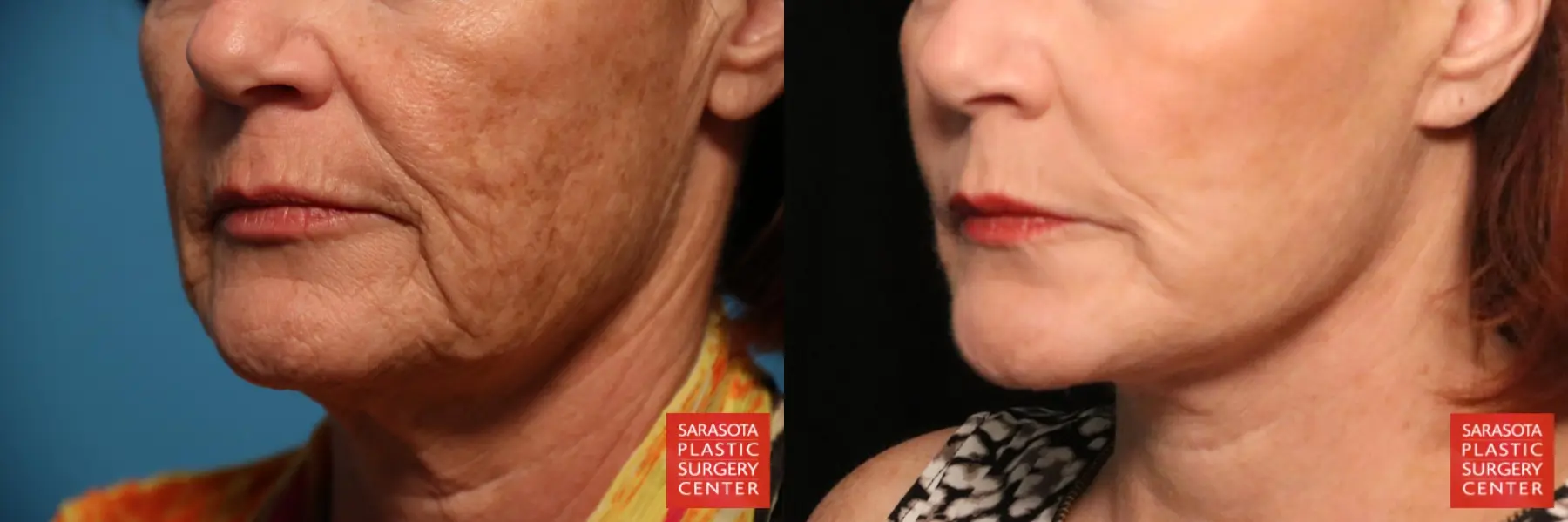 Laser Skin Resurfacing - Face: Patient 22 - Before and After 3