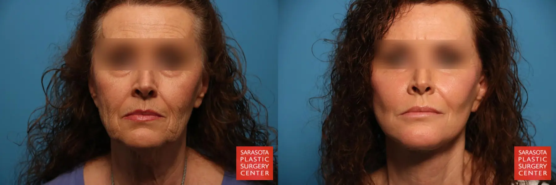 Laser Skin Resurfacing - Face: Patient 24 - Before and After  