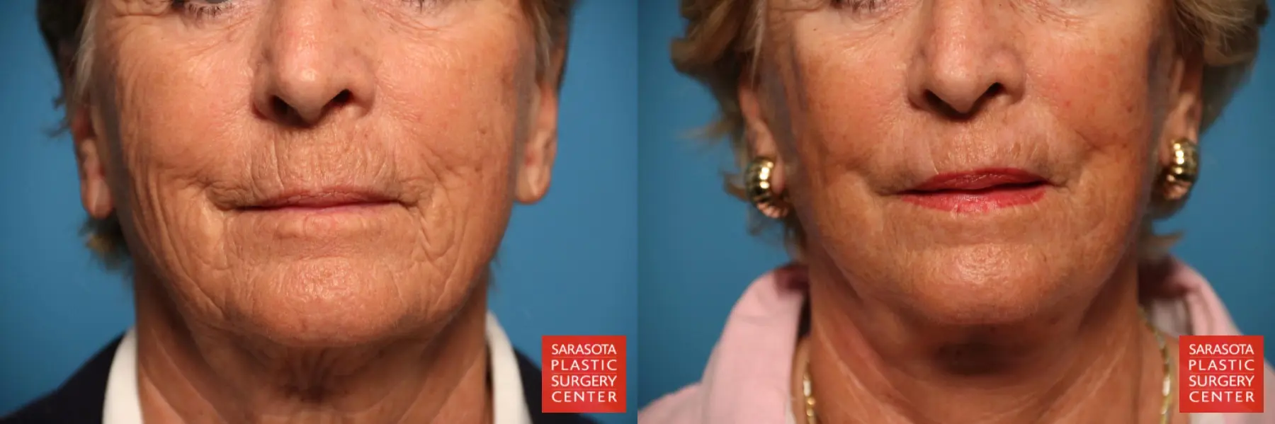 Laser Skin Resurfacing - Face: Patient 14 - Before and After  