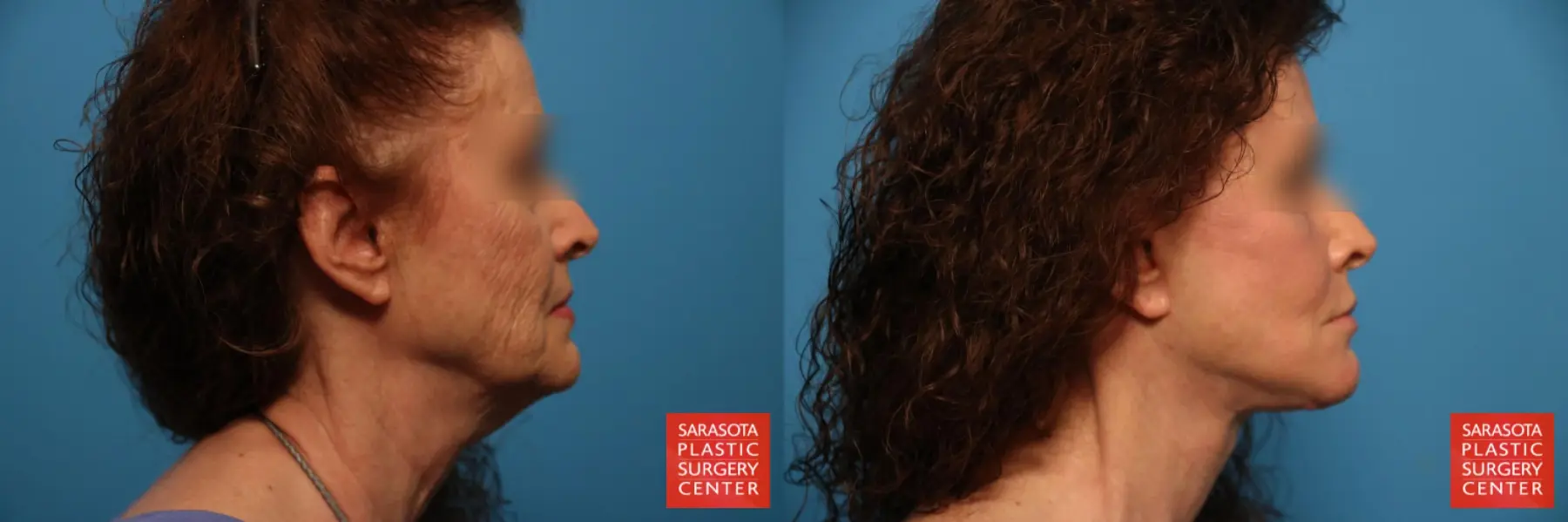 Laser Skin Resurfacing - Face: Patient 24 - Before and After 3