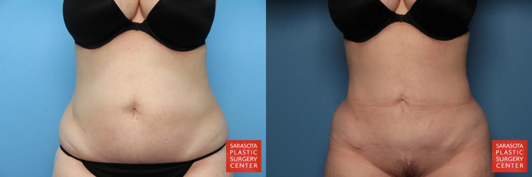 Liposuction: Patient 3 - Before and After  