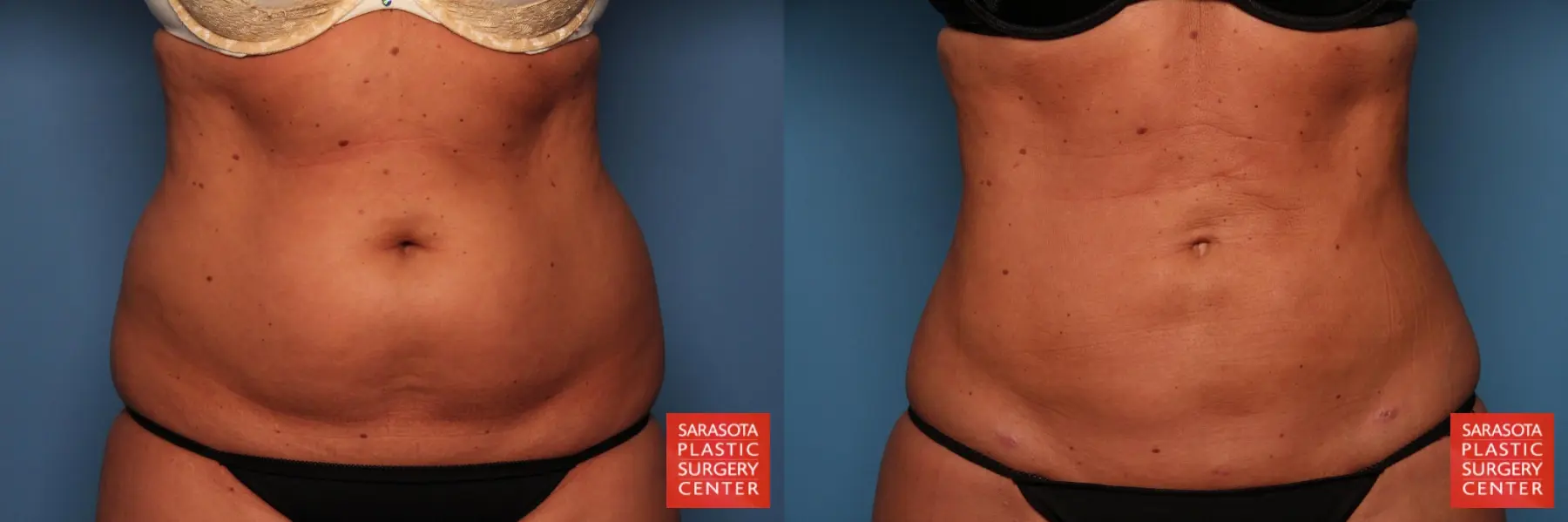 Liposuction: Patient 6 - Before and After  