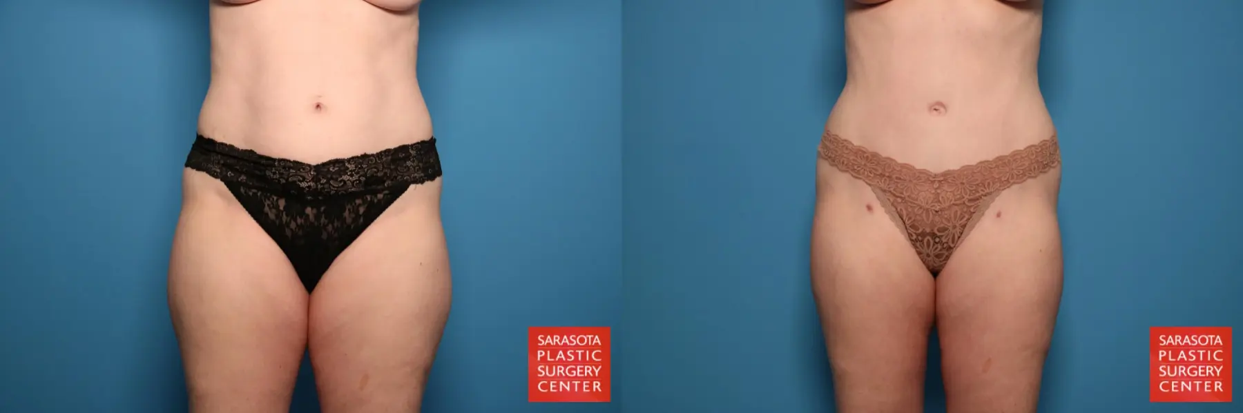 Liposuction: Patient 25 - Before and After  