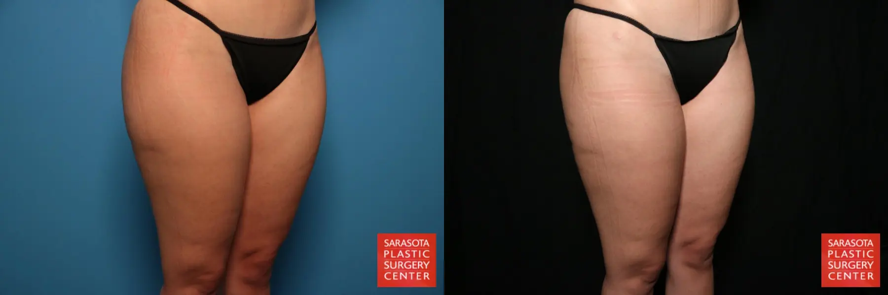 Liposuction: Patient 1 - Before and After 3