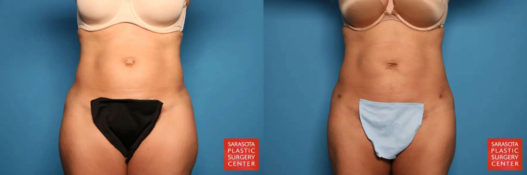 Liposuction: Patient 10 - Before and After  