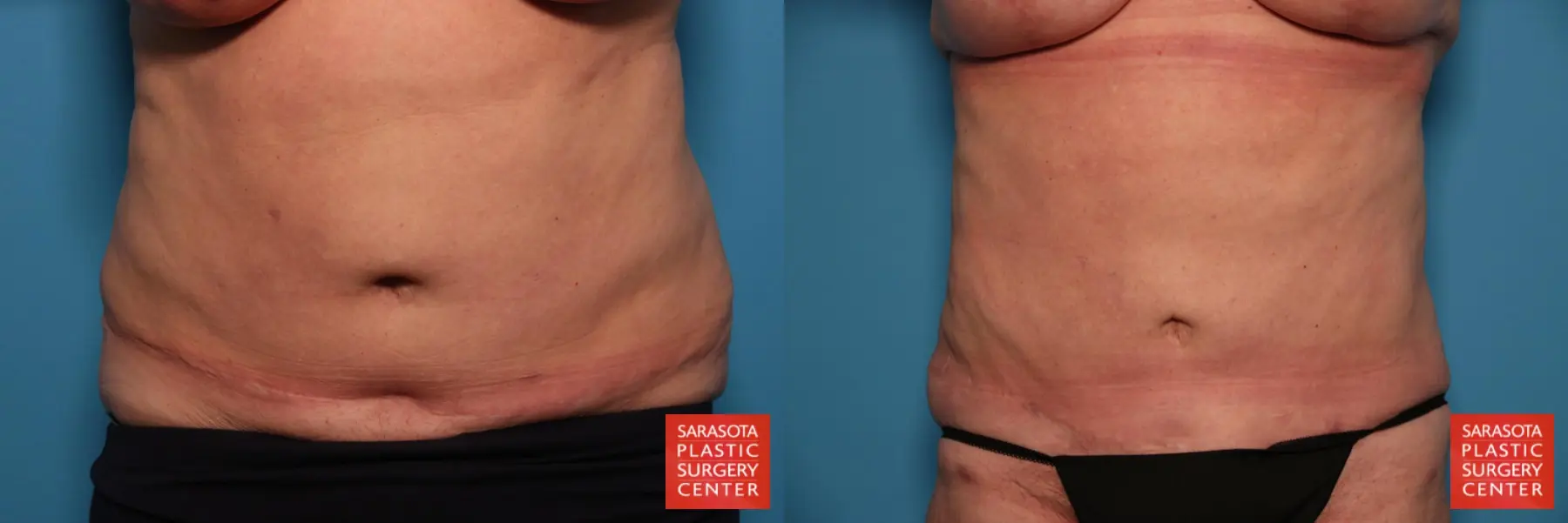 Liposuction: Patient 22 - Before and After  