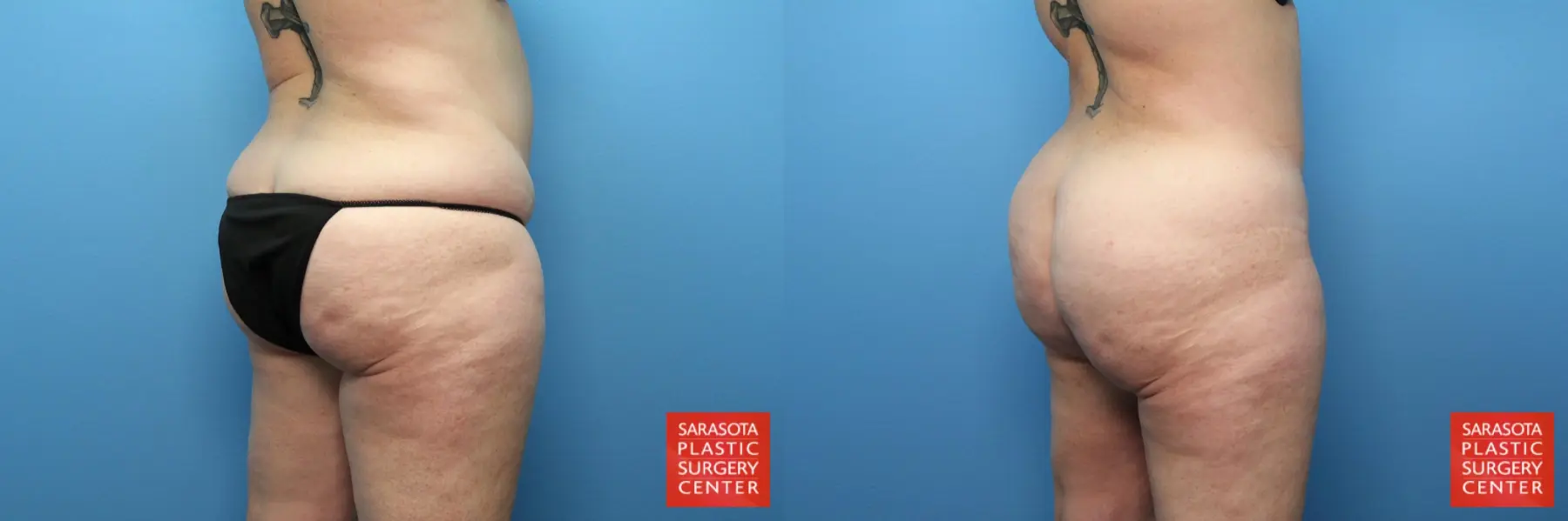 Liposuction: Patient 3 - Before and After 5