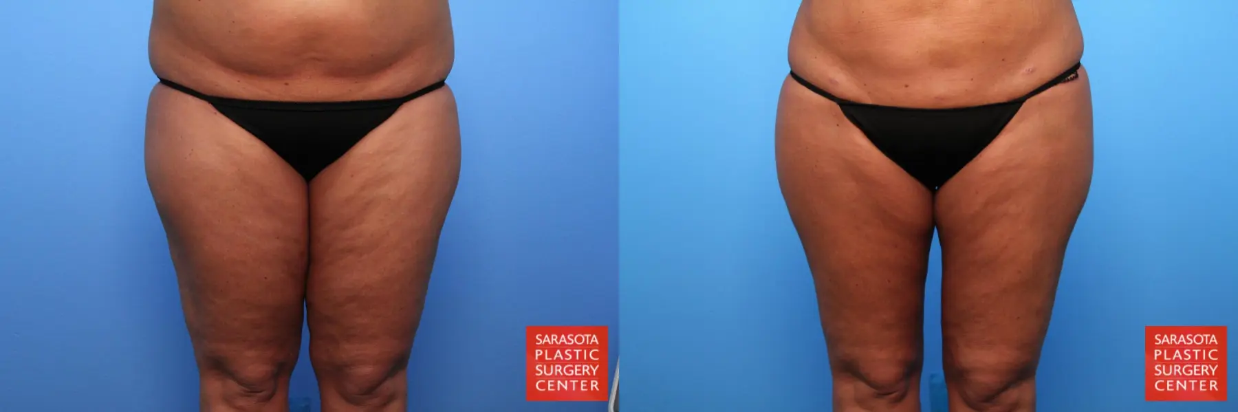 Liposuction: Patient 7 - Before and After  