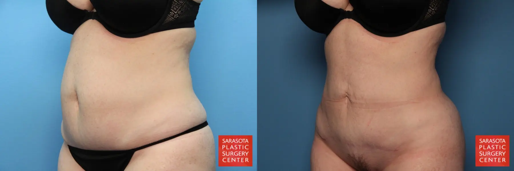 Liposuction: Patient 3 - Before and After 2
