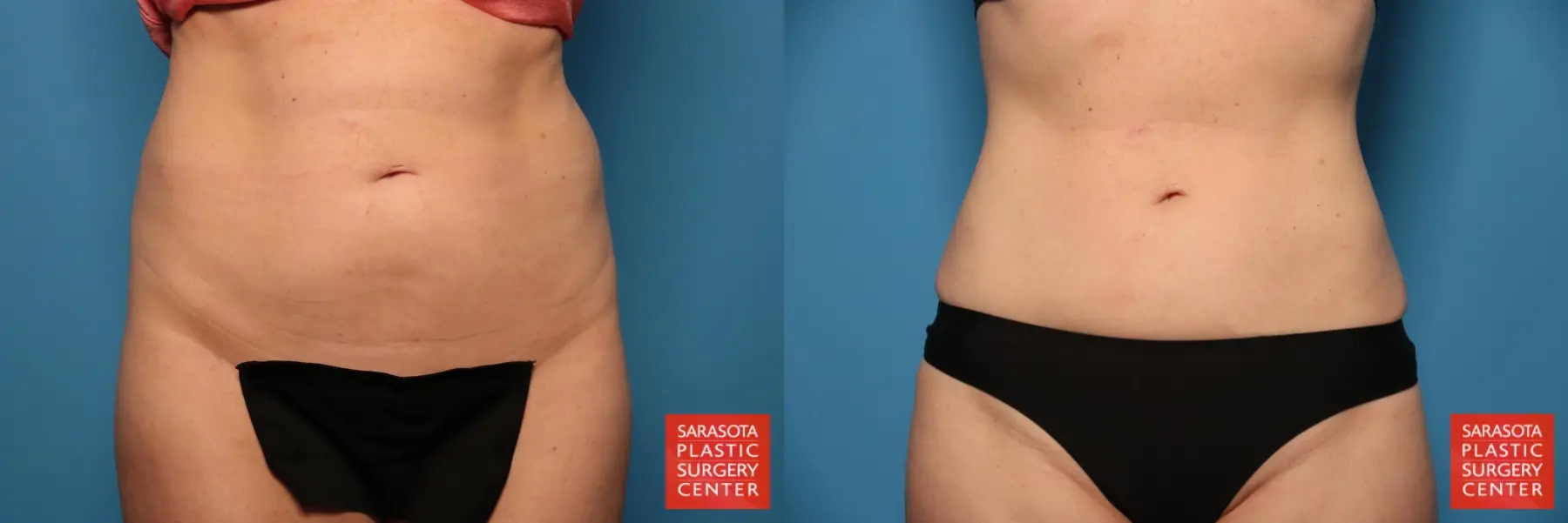 Liposuction: Patient 4 - Before and After  
