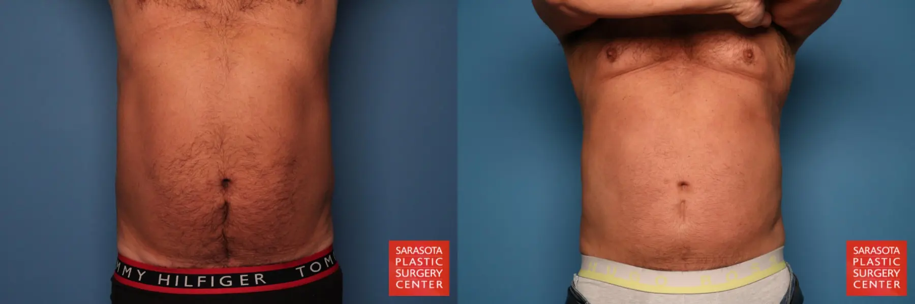 Liposuction: Patient 5 - Before and After  