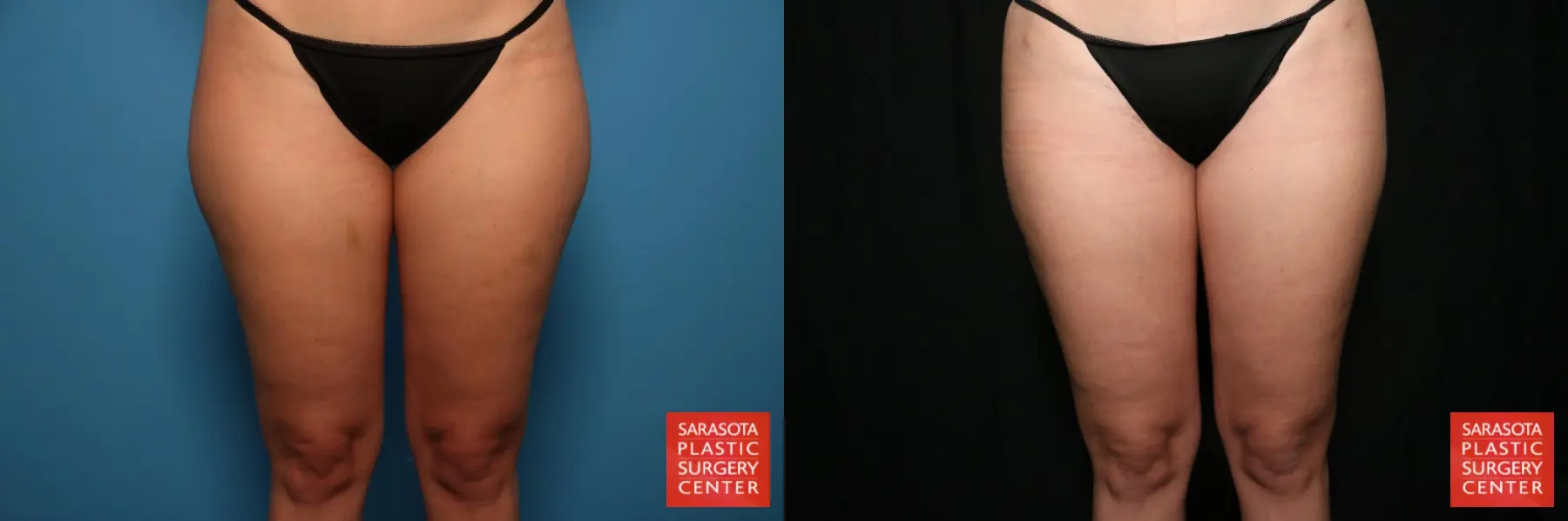 Liposuction: Patient 1 - Before and After  