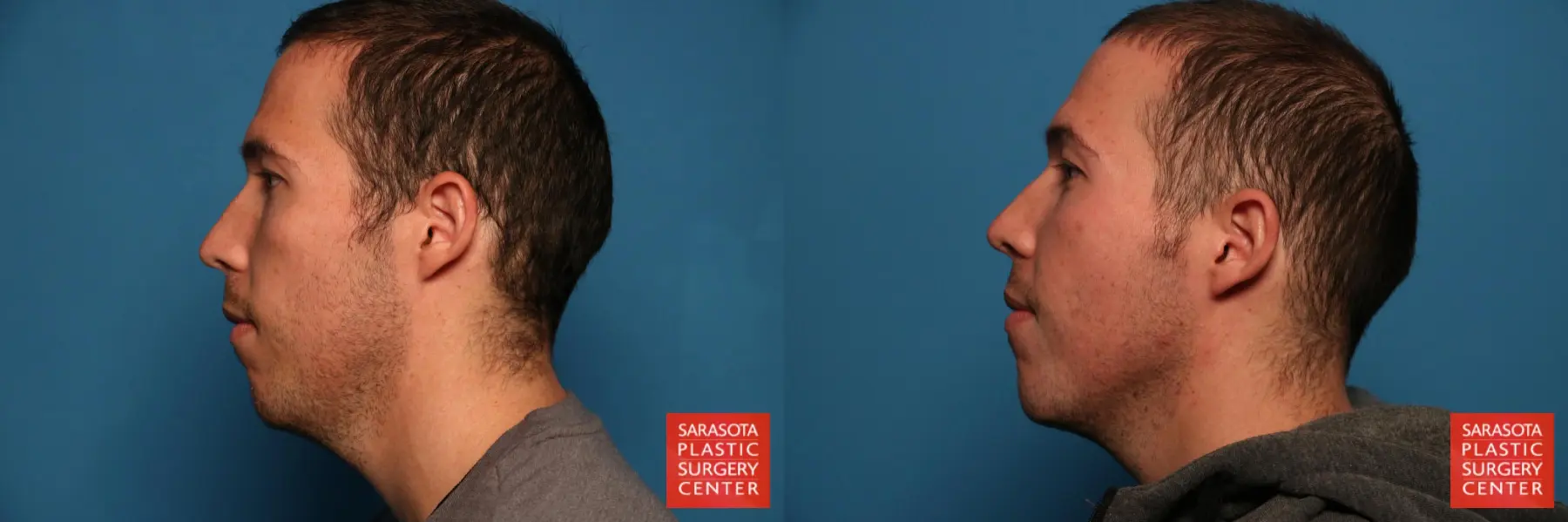 Liposuction Of The Neck: Patient 1 - Before and After  