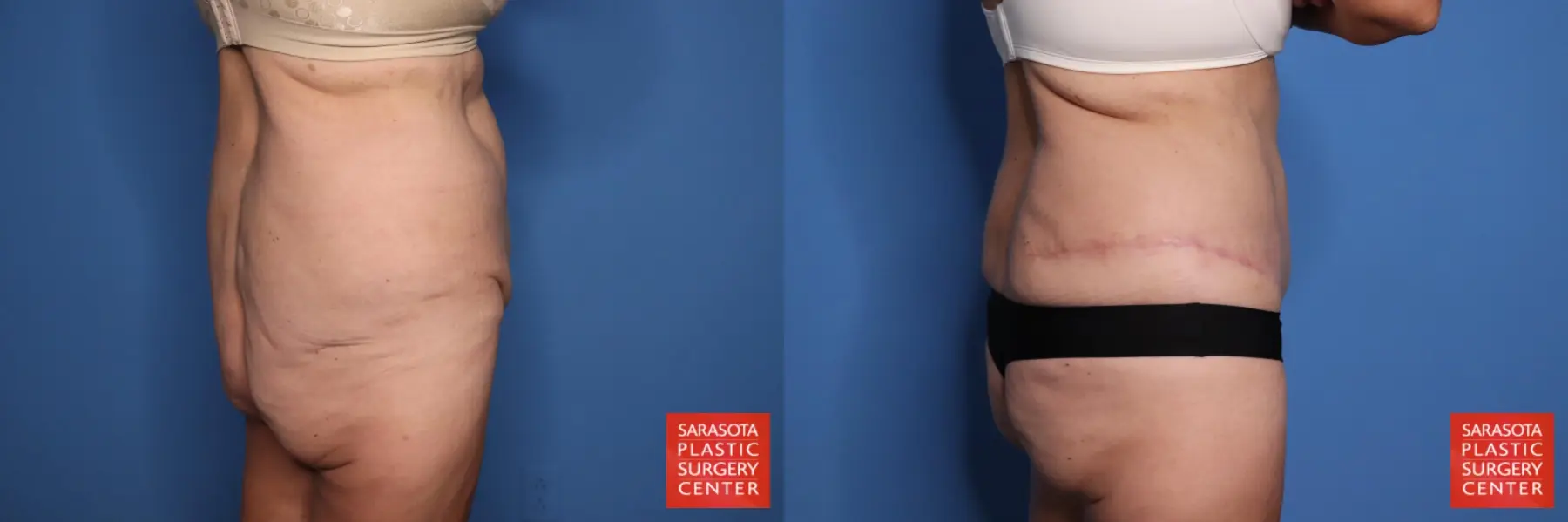 Panniculectomy: Patient 1 - Before and After 7