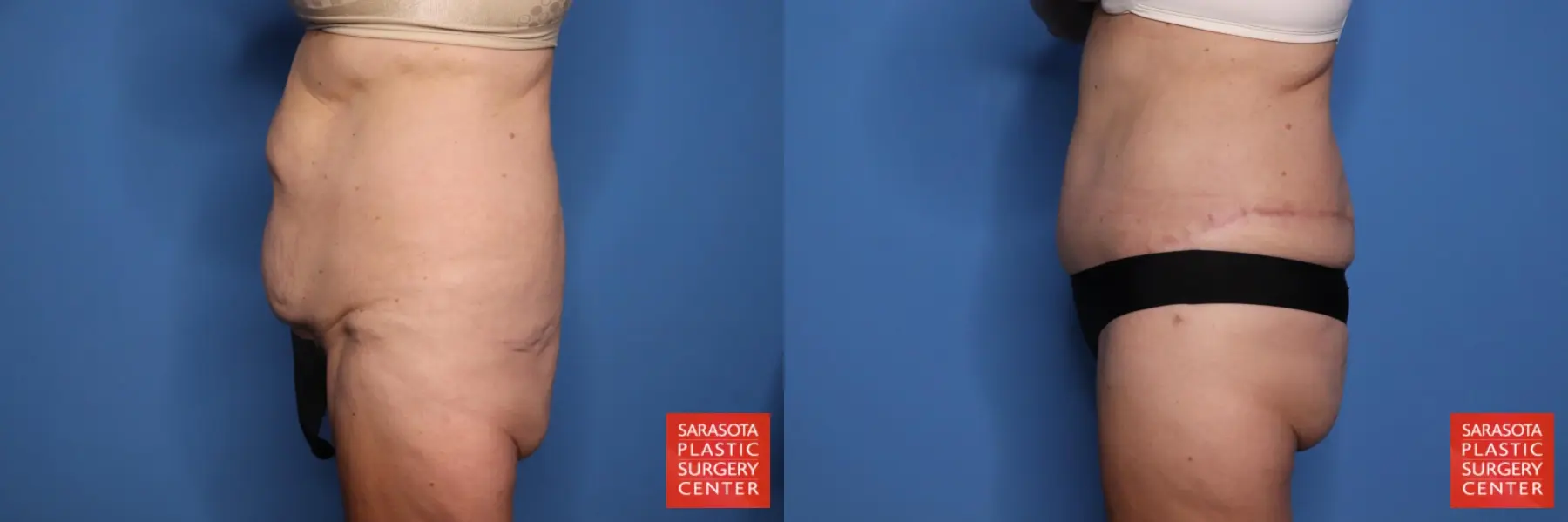 Panniculectomy: Patient 1 - Before and After 3