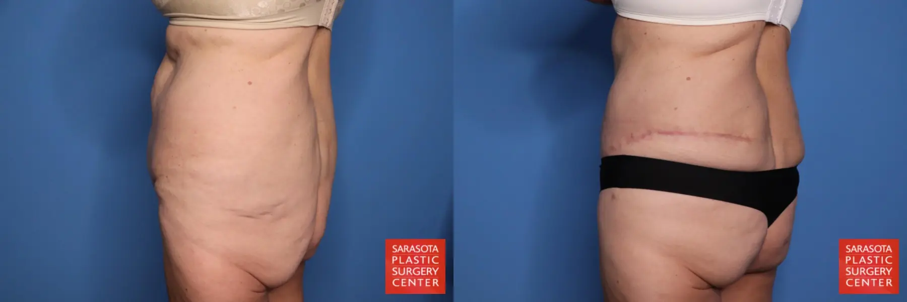 Panniculectomy: Patient 1 - Before and After 4