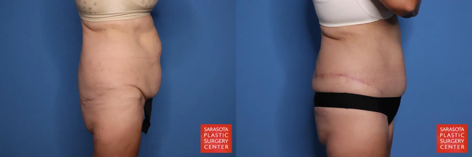 Panniculectomy: Patient 1 - Before and After 6